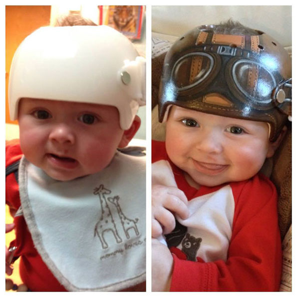 Medical Helmets For Babies