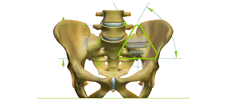 SI-BONE