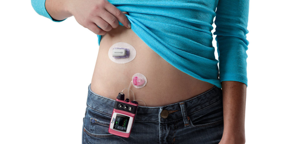 Continuous Glucose Monitor