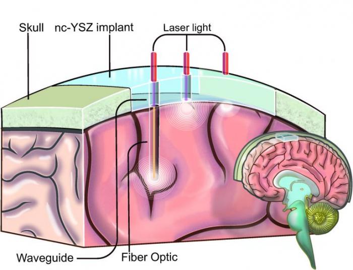 Skull Implants