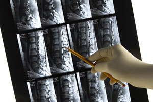 spinal implant rods