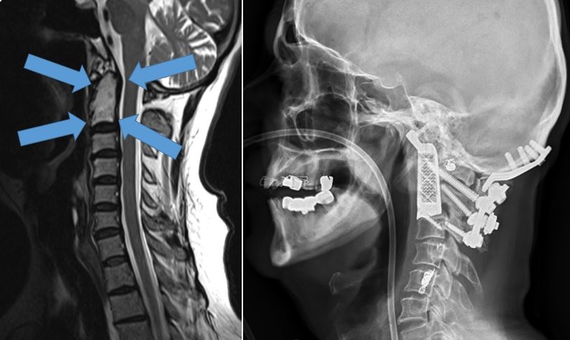 Vertebrae