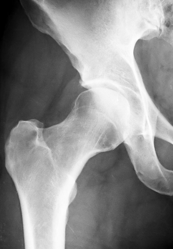 Pelvis X-Ray, human skeleton image