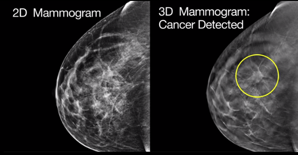 mammogram