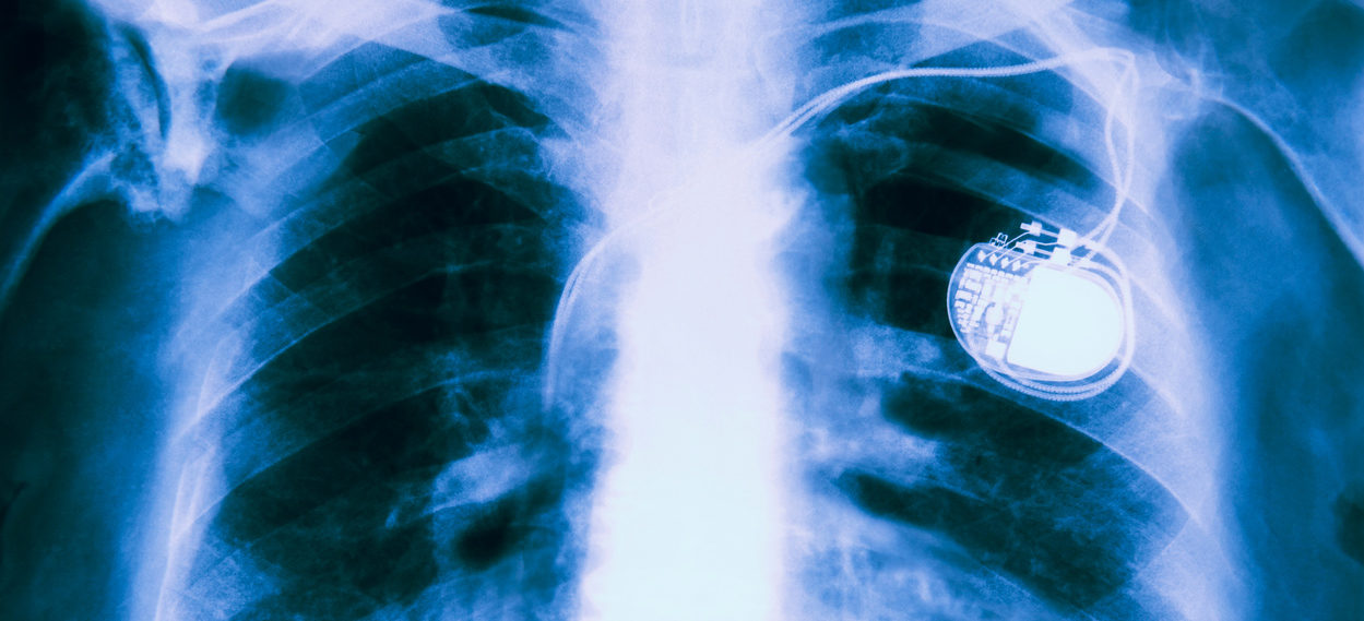 X Ray Of Chest Showing Pacemaker Fitted