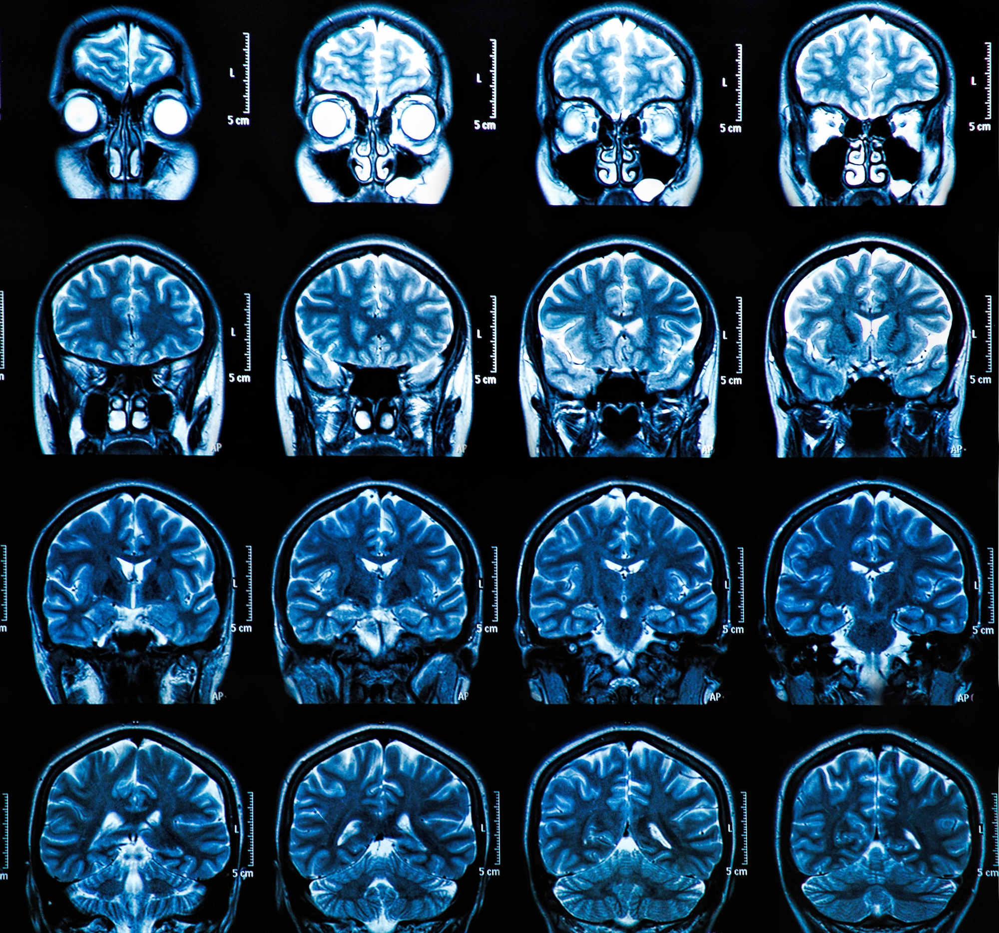 Магнитно резонансная томография головного мозга энцефалопатия