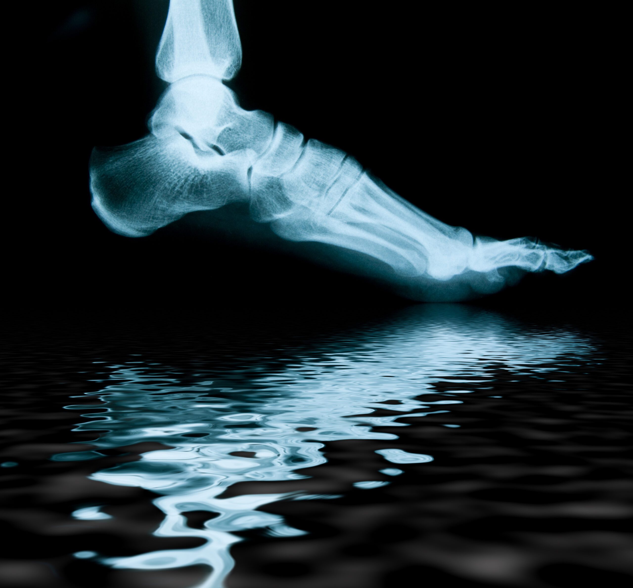 Radiografia del piede con riflesso