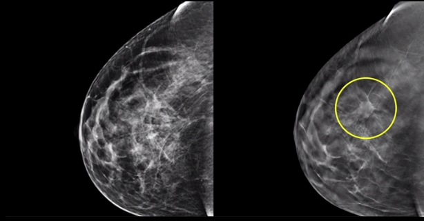 edited mammograpm