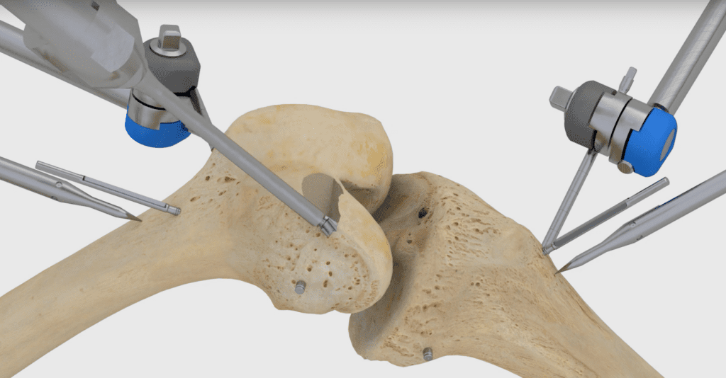 Knee Replacement Robot