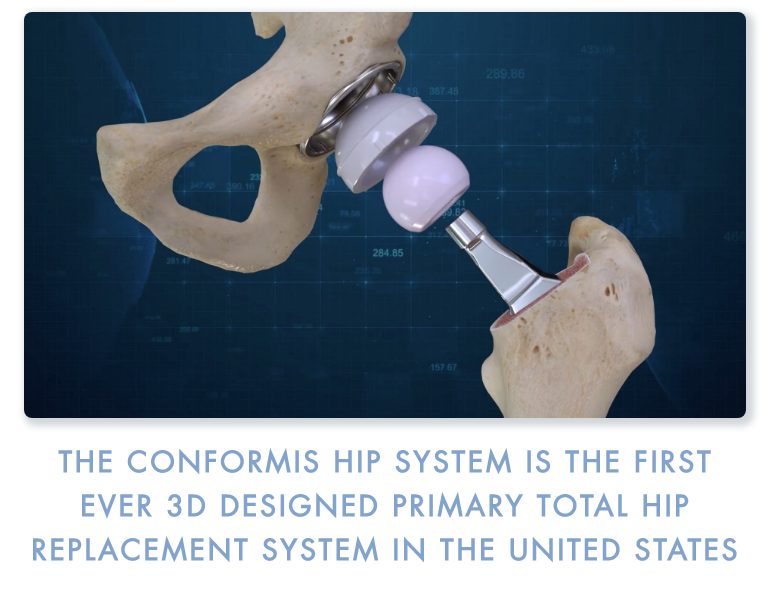 Conformis Hip System