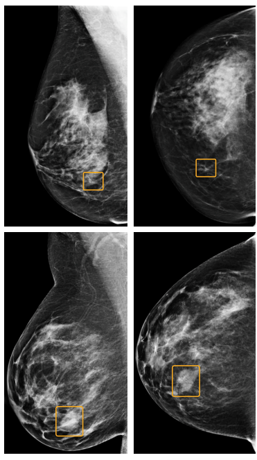 Breast Cancer Identification Imaging