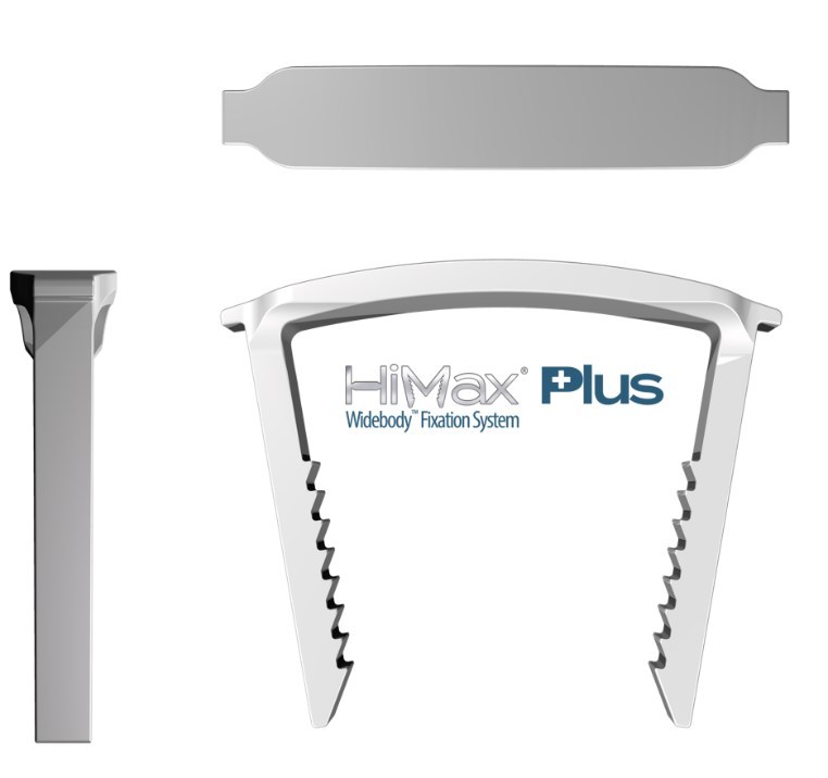 HiMax® Plus Widebody™ Fixation System for Foot Fusions: Market Leading Compression Plus Enhanced Stability
