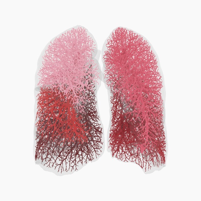 Image of bloodvessels in the different lobes of the lungs, based on Functional Respiratory Imaging (FRI) technology