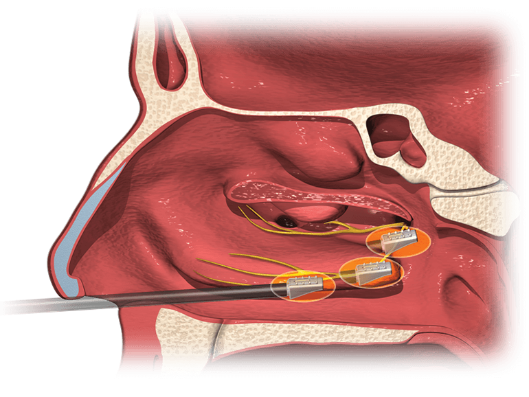 aerin-image-nasal