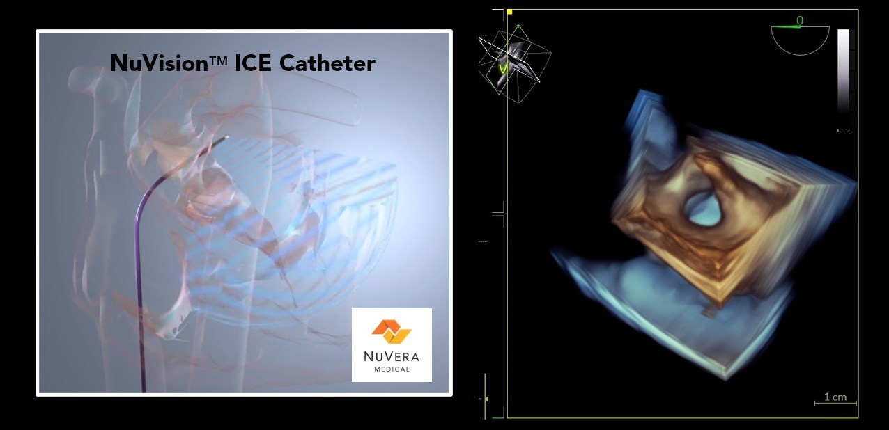 The NuVision™ ICE Catheter guided treatment of an atrial septal defect in NuVera's successful first-in-human use lead by principal investigator Adrian Ebner, M.D. The novel catheter is designed to offer interventional cardiologists and electrophysiologists rapid, real-time 3D, multi-planar insights into structural heart and cardiac ablation, which are difficult to detect with current technology and may require general anesthesia.