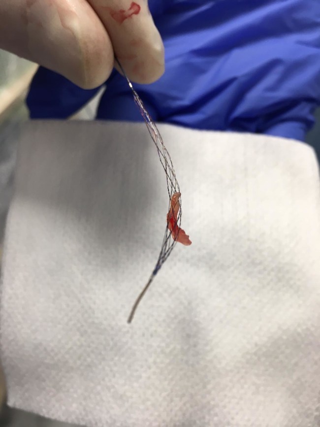 Clot removed from the brain of the 1st stroke patient treated with Tigertriever XL at Bochum University Hospital