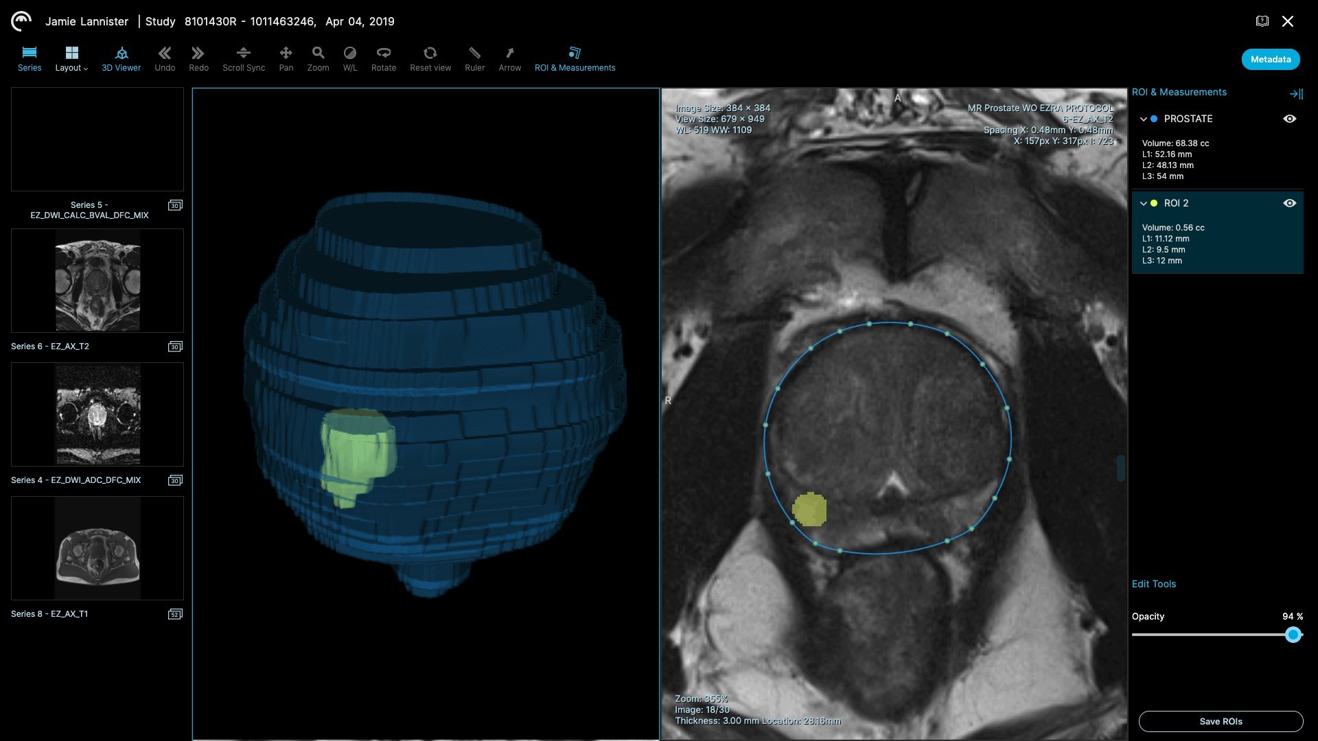 AI-powered prostate lesion in 3D