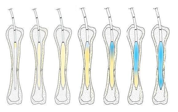 IlluminOss-Bone-Stabilization