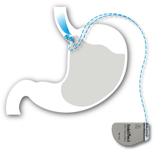 EndoStim-System